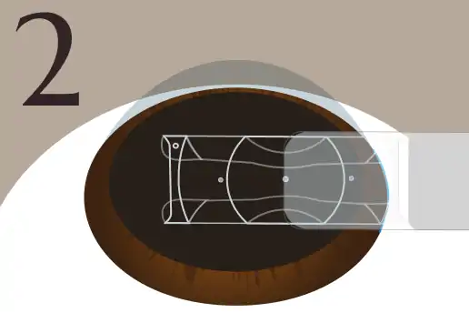 ICL挿入のイメージ画像